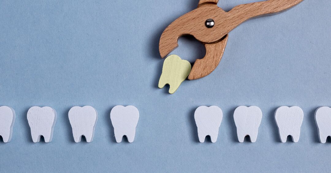 Benefits to Removing All 4 Wisdom Teeth