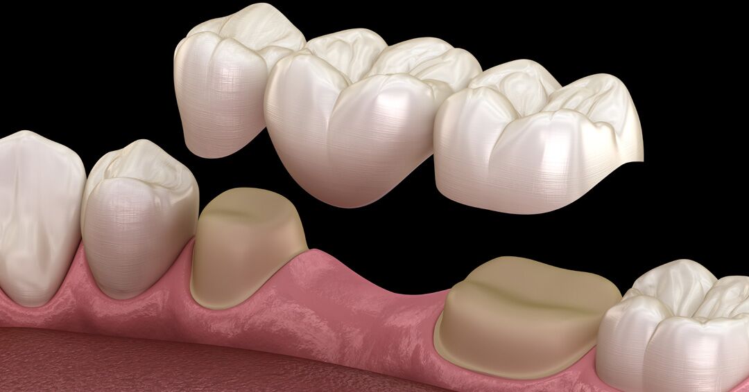 5 Types of Dental Bridges and Who May Need Them